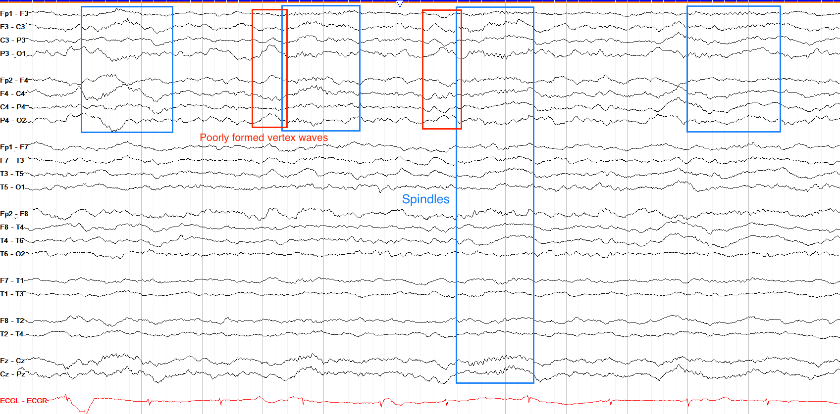 The Normal Asleep EEG